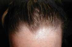 Non-Surgical Hair Transplant | Hair Replacement Systems
