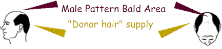 male_pattern_baldness