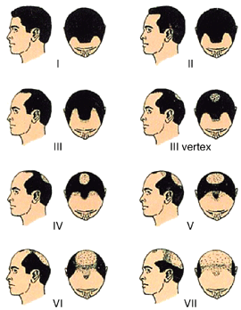 norwood_scale